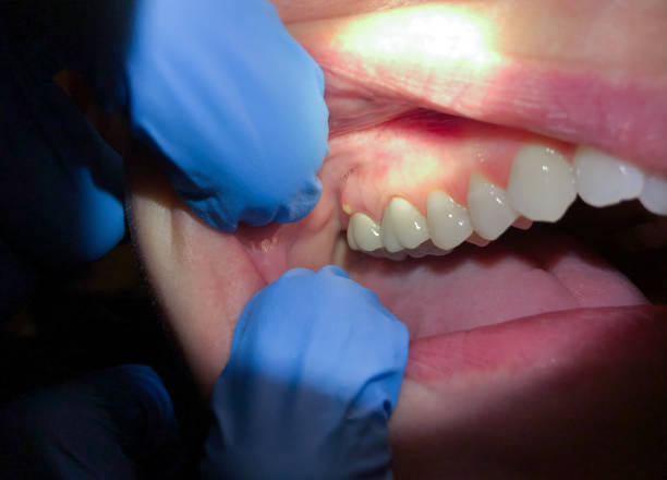 Best Emergency Root Canal Treatment in Hidden Valley, IN